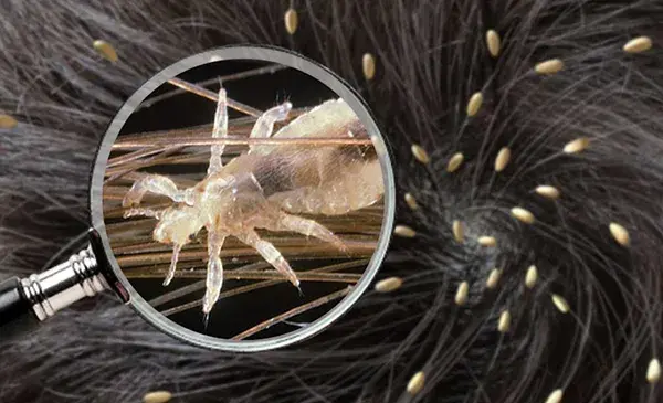 عکس شپش با ذره بین