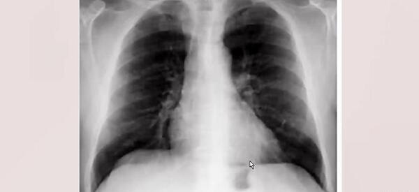 عکس ریه ناسالم کودکان