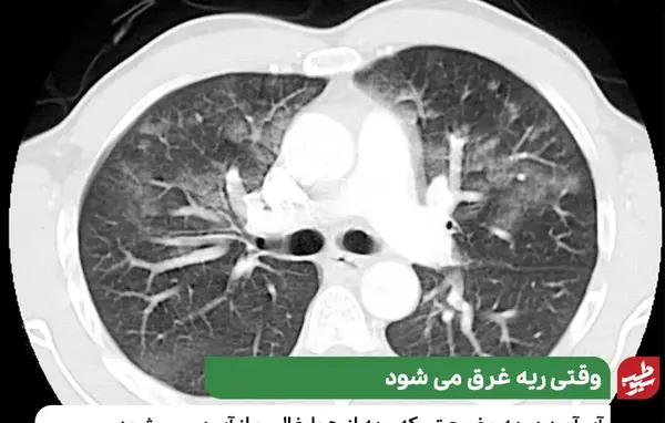 عکس ریه ناسالم کودکان