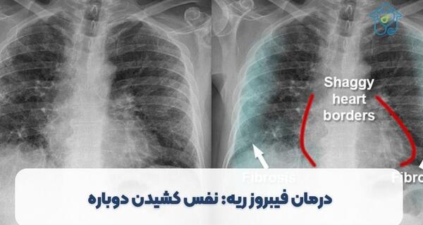 عکس ریه ناسالم کودکان