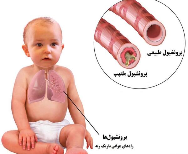 عکس ریه نوزاد نارس