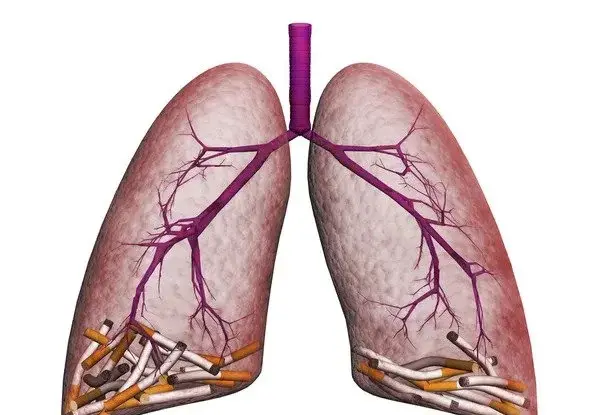 عکس واقعی ریه سیگاری