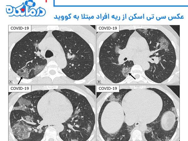 عکس ندول ریه در سی تی اسکن