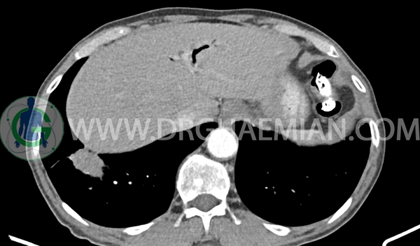 عکس ندول ریه در سی تی اسکن