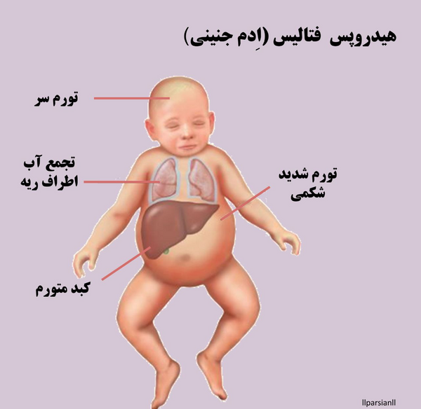 عکس گرفتن از ریه نوزاد