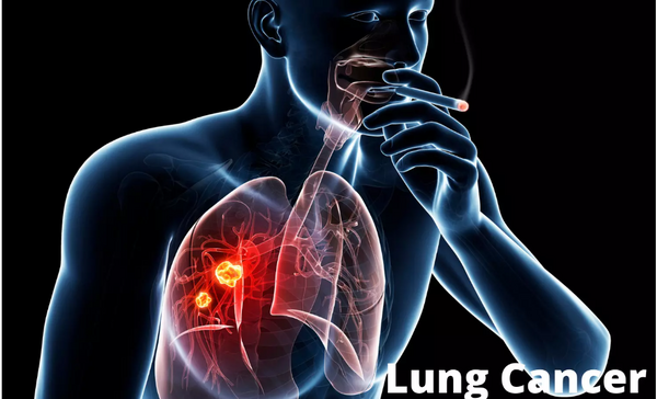عکس سی تی اسکن ریه فرد سیگاری