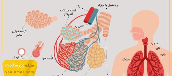 عکس ریه عفونت کرده نوزاد