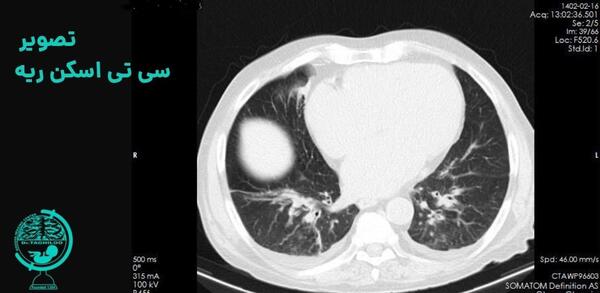 عکس رادیولوژی ریه عفونت کرده