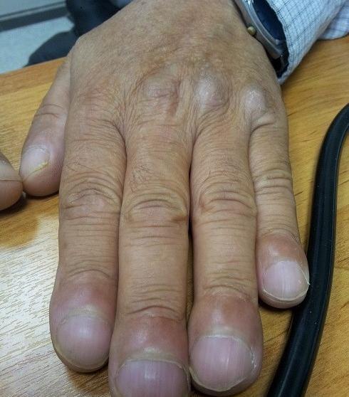 عکس ریه های سرطانی