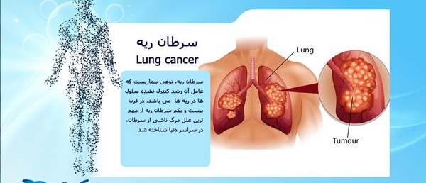 عکس توده سرطانی ریه