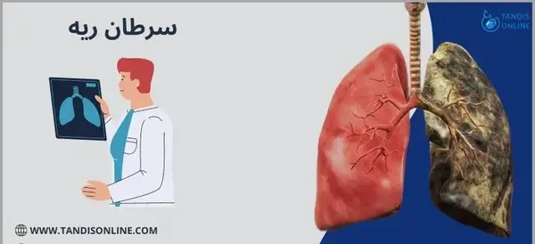 عکس از ریه سرطانی