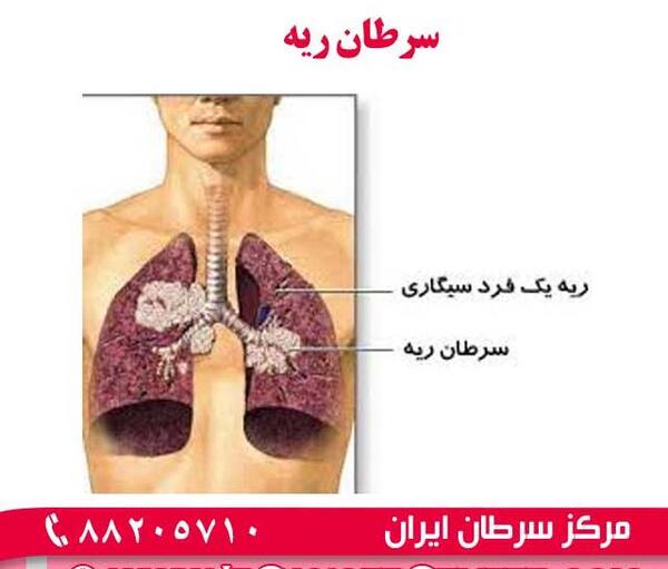 عکس از ریه سرطانی