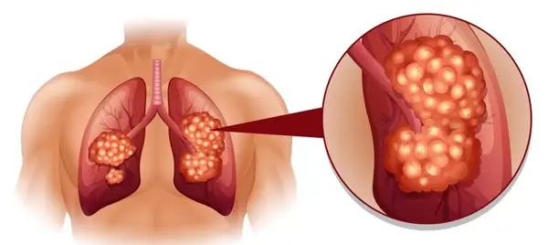عکس از ریه سرطانی