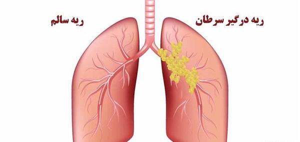 عکس ریه فرد سرطانی