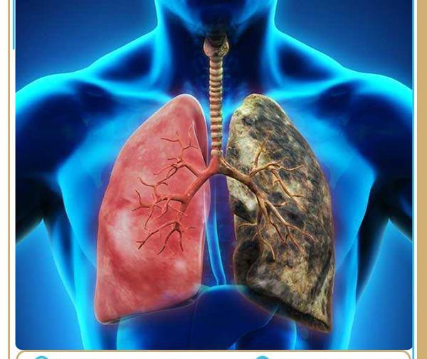عوارض عکس رنگی ریه