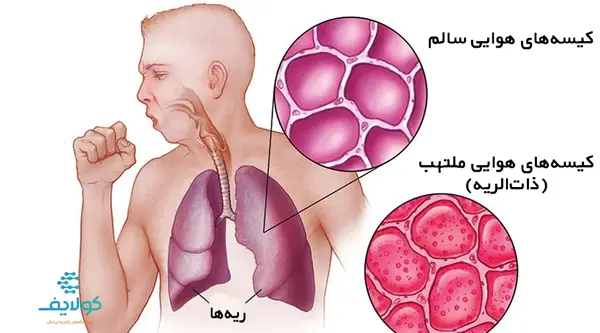 عکس ریه ذات الریه
