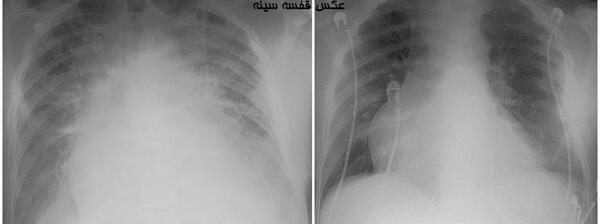 عکس ریه ذات الریه