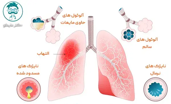 عکس ریه ذات الریه