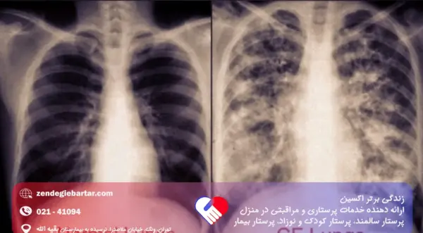 عکس ریه درگیر کودک