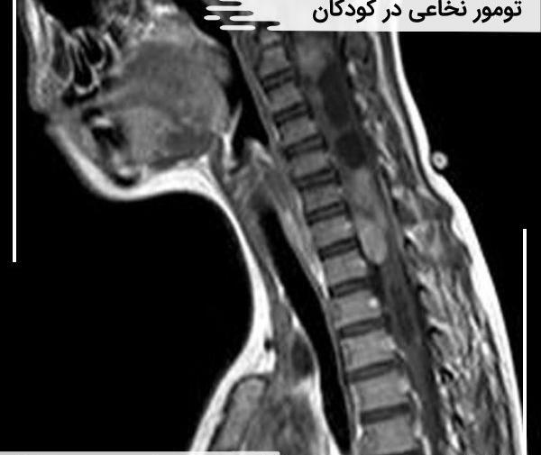 عکس ریه درگیر کودک