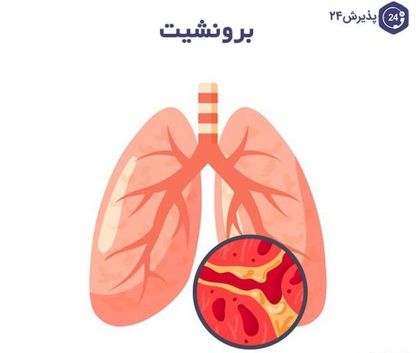 عکس خلط در ریه