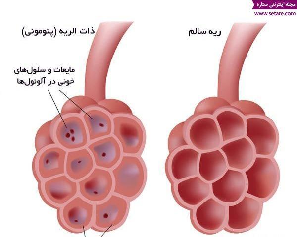 عکس خلط در ریه