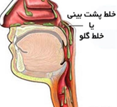 عکس خلط در ریه