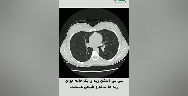 عکس ریه های خراب