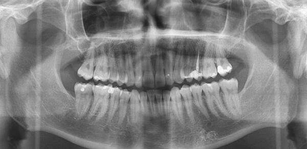 عکس سی تی اسکن ریه خراب