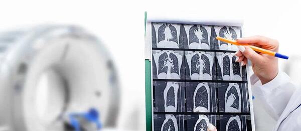 عکس ریه حساسیت