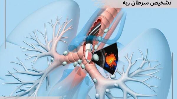 عکس جواب آزمایش سرطان ریه