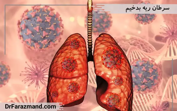 عکس تومور در ریه