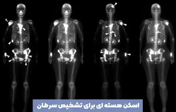 عکس تومور در ریه