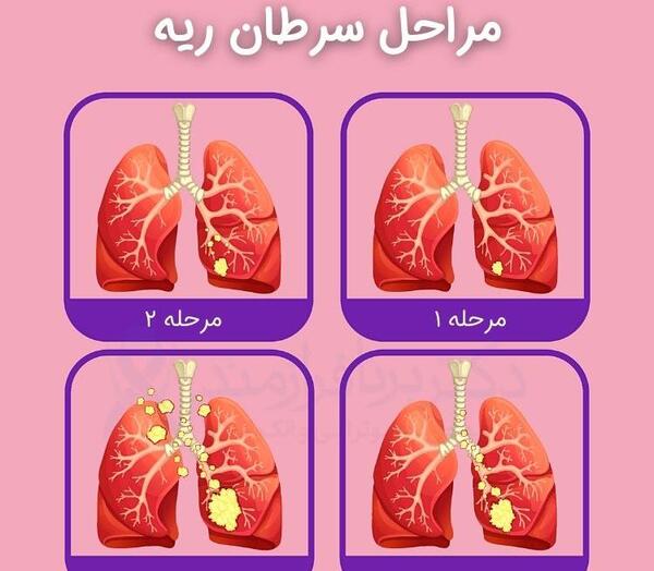 عکس تومور در ریه
