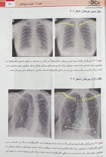 تحلیل عکس رادیولوژی ریه