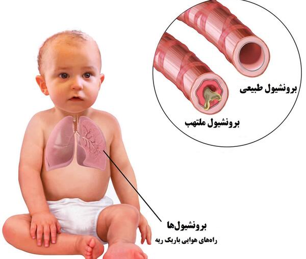 عکس ریه عفونی کودک