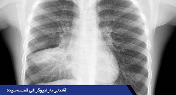 هزینه عکس ریه برای کرونا