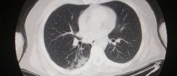 عکس گرفتن از ریه برای کرونا