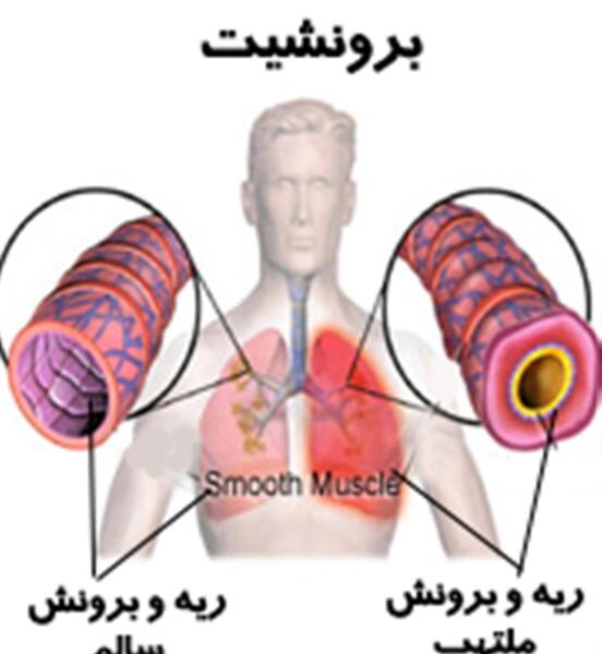 عکس ریه برونشیت حاد
