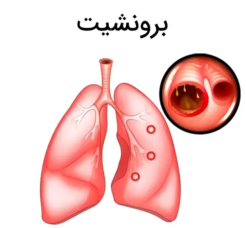 عکس ریه برونشیت حاد