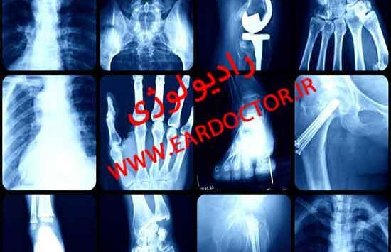 عکس رادیولوژی ریه آب آورده