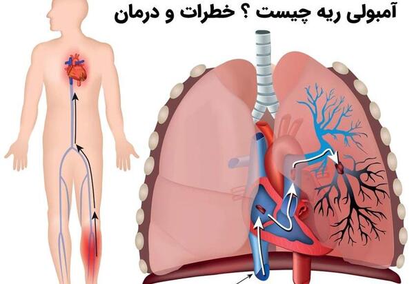 عکس های از آمبولی ریه