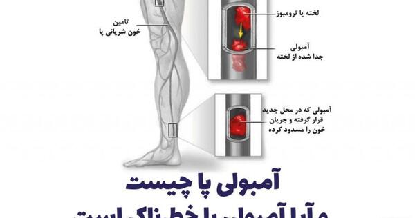 عکس از آمبولی ریه
