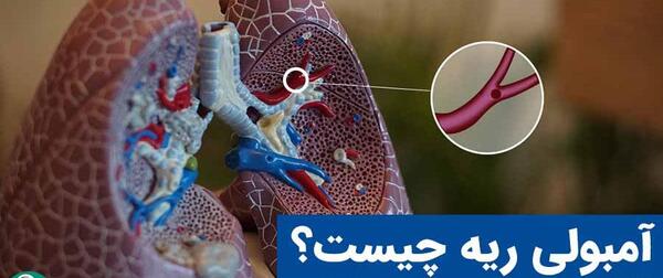 عکس از آمبولی ریه