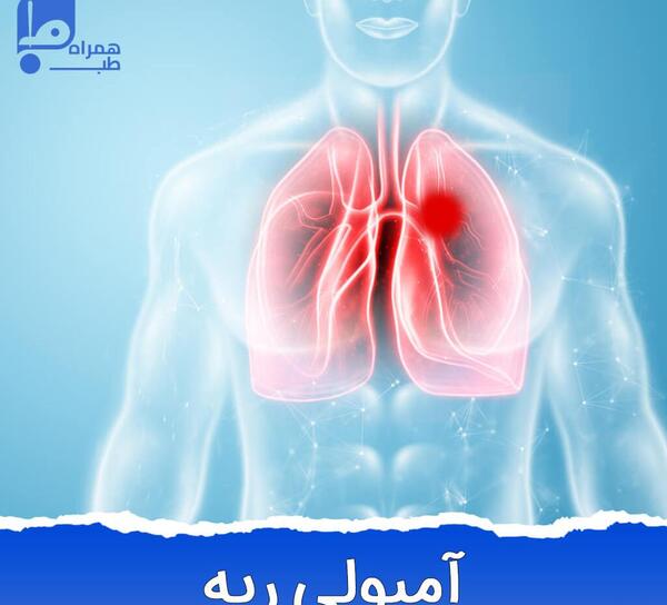 عکس از آمبولی ریه