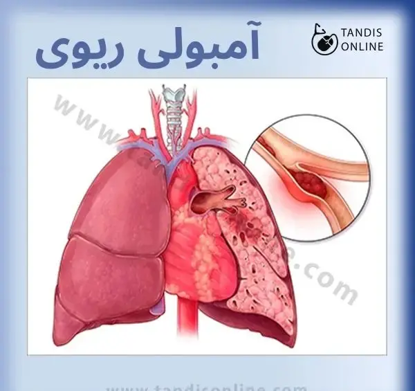 عکس از آمبولی ریه