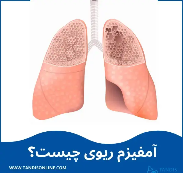 عکس آمفیزم ریه