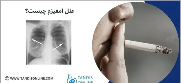 عکس آمفیزم ریه