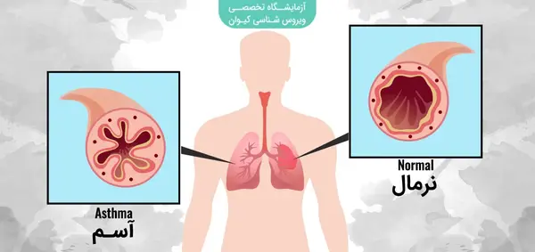 عکس ریه بیماران آسمی