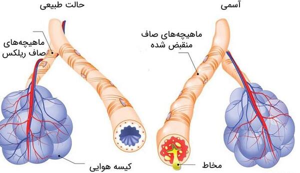 عکس ریه بیماران آسمی